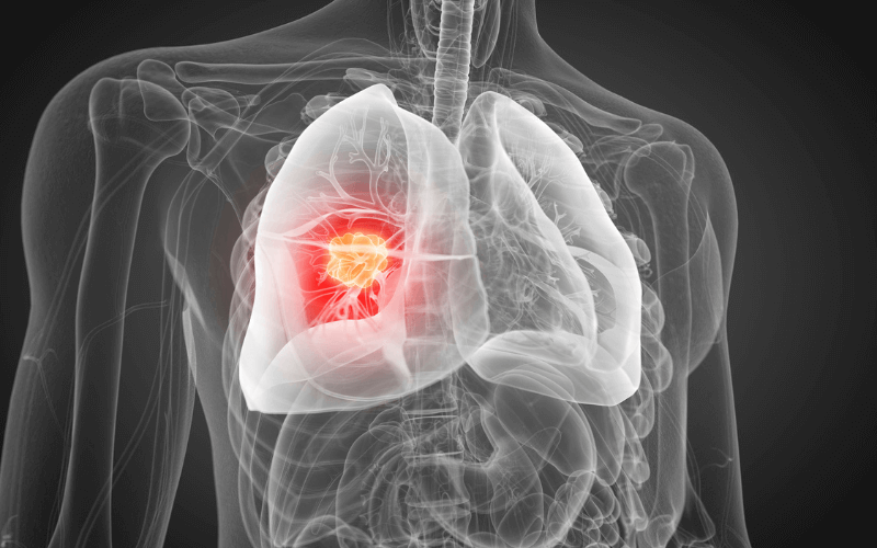 Asbestos Exposure campaign